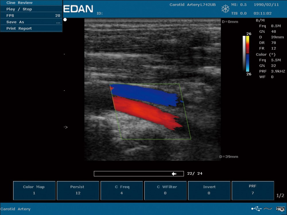 7-1-color-dopper-imaging-of-vertebral-artery-.jpg